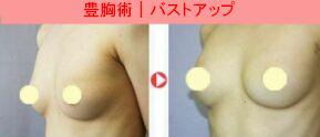 豊胸術 脂肪注入法 症例写真