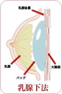 豊胸手術|症例 写真|画像