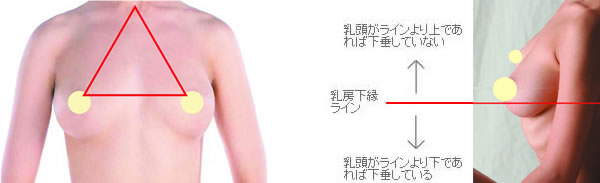 マストペクシー|乳房挙上