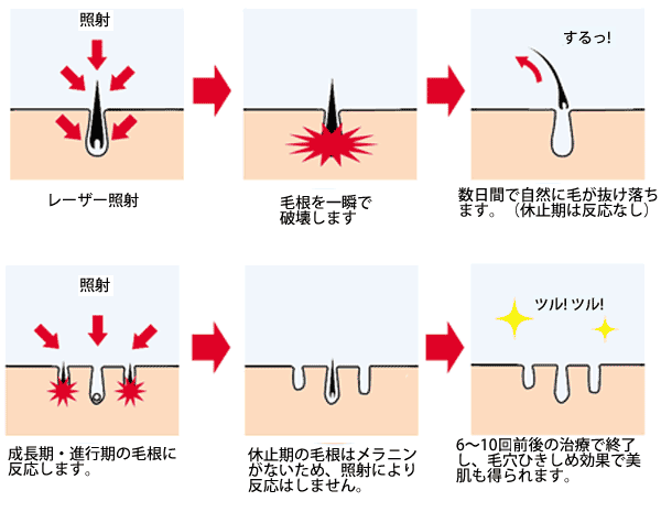 レーザー脱毛|医療レーザー脱毛(永久脱毛)