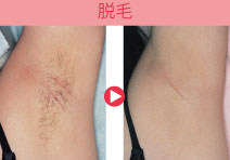 脇脱毛|医療レーザー脱毛(永久脱毛)