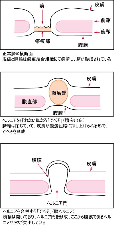 でべそ