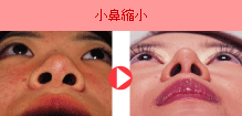 小鼻縮小