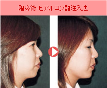 隆鼻術
