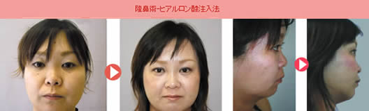 隆鼻術−ヒアルロン酸注入