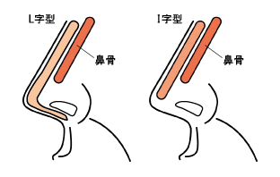 プロテーゼ|隆鼻術