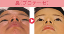 鼻プロテーゼ|隆鼻術