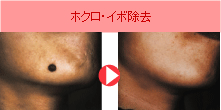 黒子除去
