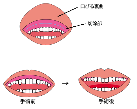 S؏@|O(т)̐`