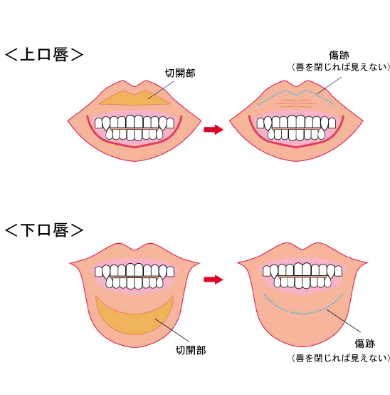 唇切開|口唇(くちびる)の整形