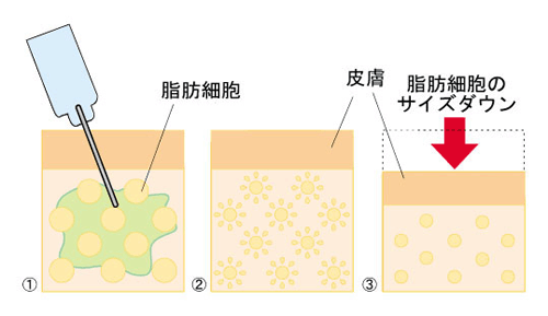 メソセラピー|脂肪吸引