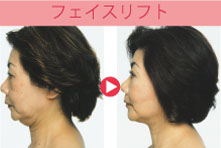 フェイスリフト