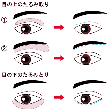 目のたるみとり