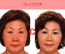 フェイスリフト