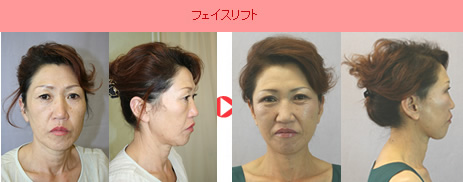 フェイスリフト
