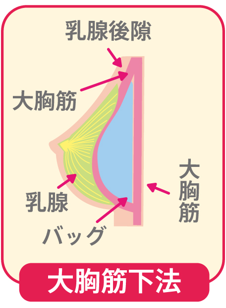 大胸筋下法