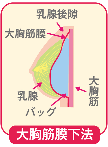 大胸筋膜下法