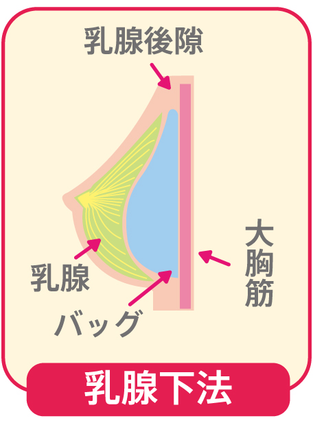 乳腺下法とは