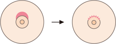 乳輪挙上（三日月型切開法）