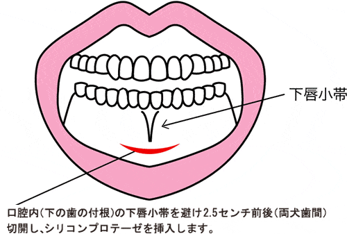 プロテーゼ法