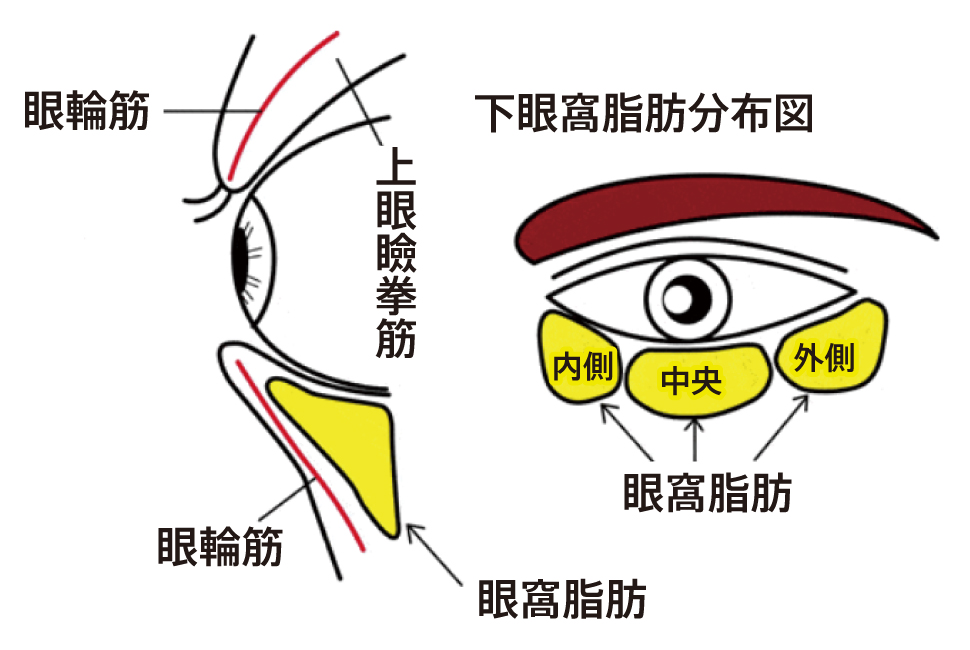 下眼瞼脂肪除去