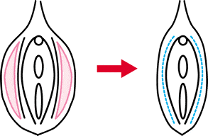 大陰唇縮小法