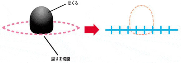 切開法のイメージ