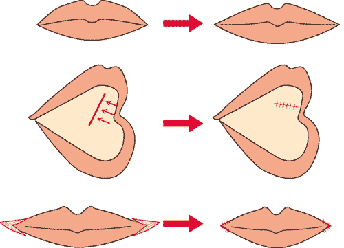 切開法