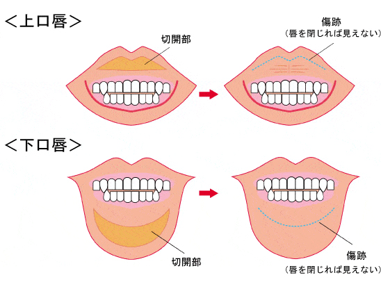 口唇縮小