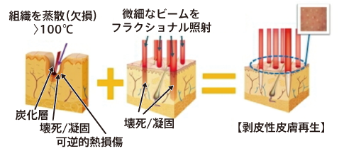 フラクショナルレーザーの説明