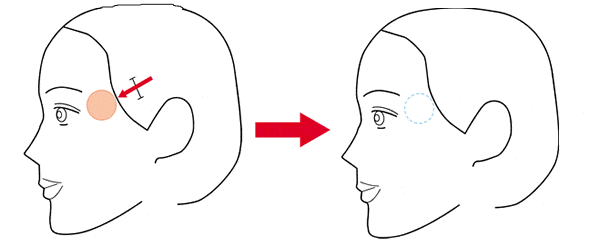 こめかみの整容 プロテーゼ法（こめかみ）