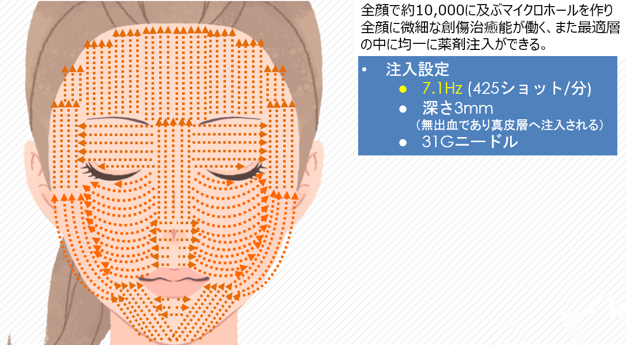 フレンチショットメソスキンリニュー