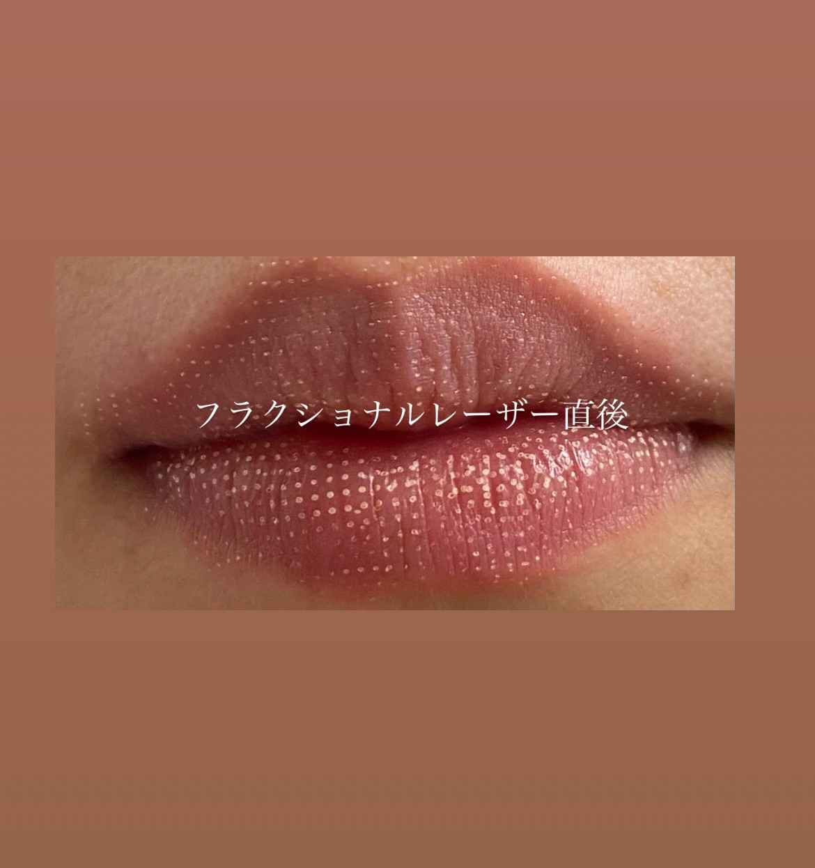 リップティント　大宮中央クリニック