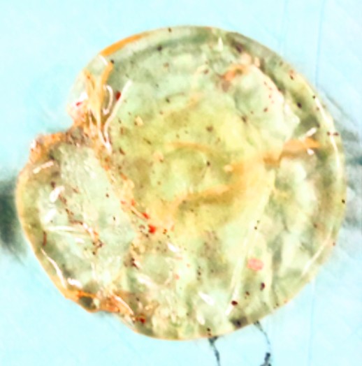 豊胸バッグ抜去｜被膜や石灰化が付着したシリコンバッグ（症例写真①）