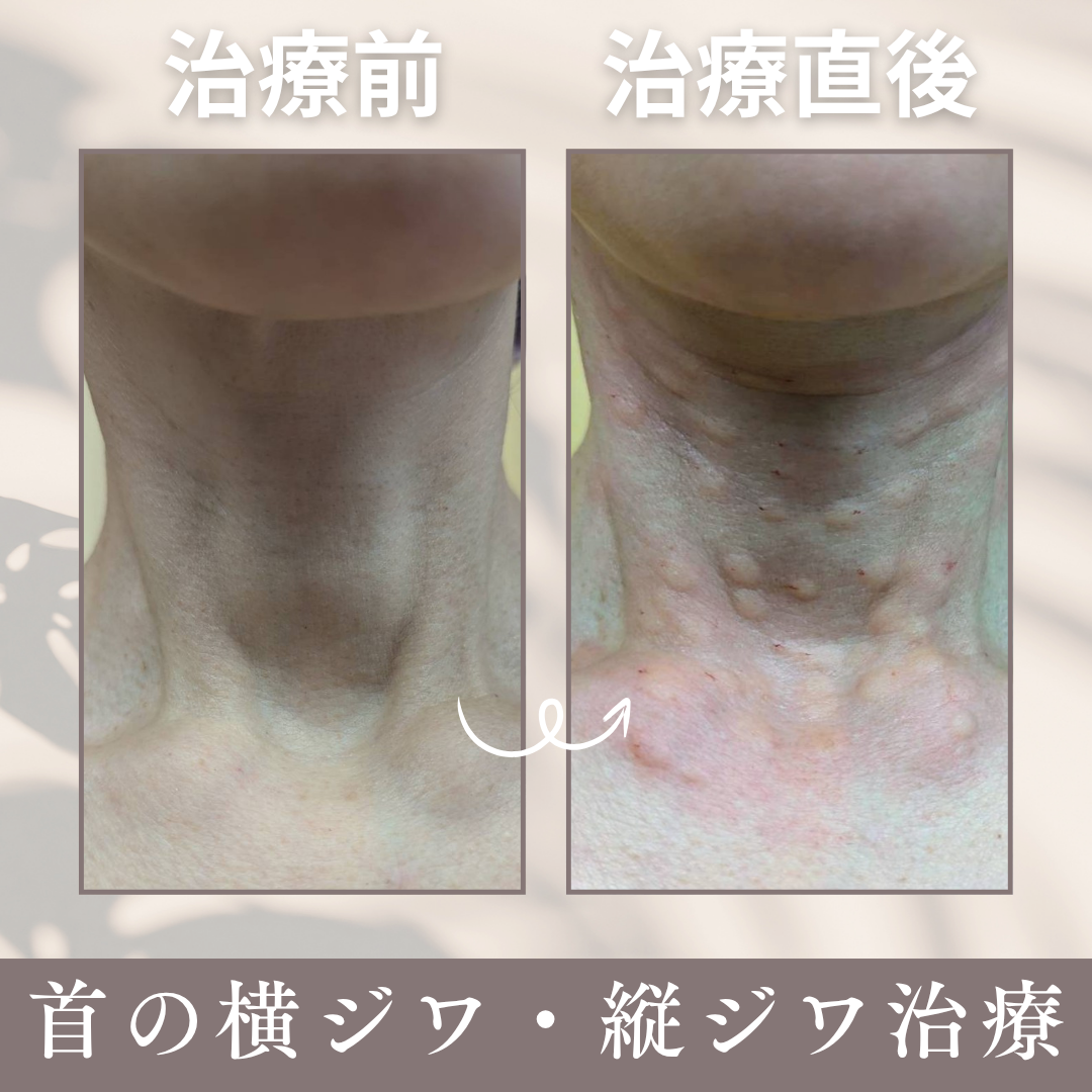 首の縦ジワ横ジワ大宮中央クリニック