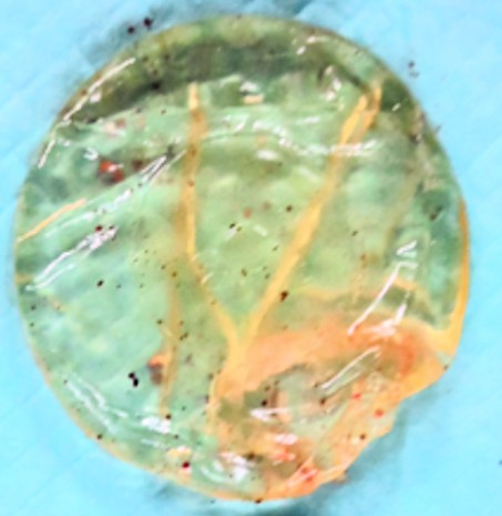 豊胸バッグ抜去｜変形や石灰化が見られるシリコンバッグ（症例写真②）