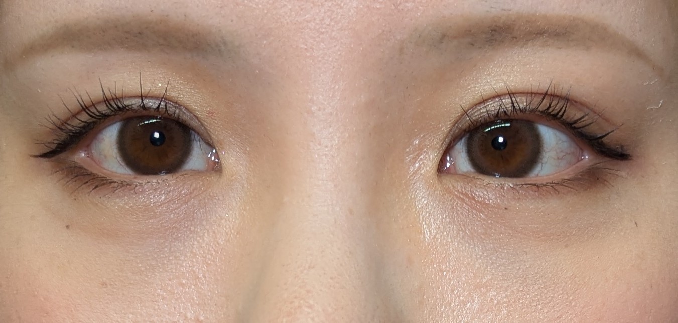 【20代】クマ取り治療（経結膜脱脂術）症例写真 治療後2ヶ月