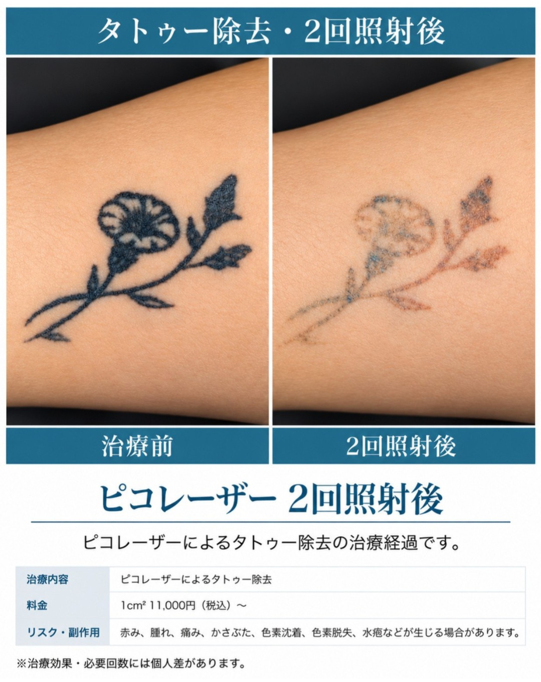 大宮中央クリニック ピコレーザーによる花のタトゥー除去 治療前と2回照射後
