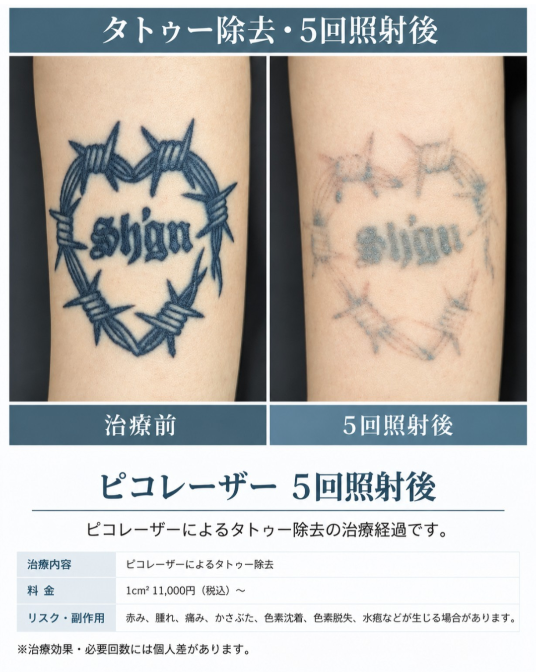 大宮中央クリニック ピコレーザーによる有刺鉄線ハートのタトゥー除去 治療前と5回照射後