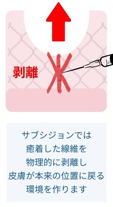 サブシジョンで癒着した線維を物理的に剥離し皮膚が本来の位置に戻る環境を作る図