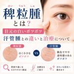 稗粒腫とは？目元の白いポツポツと汗管腫との違いについて