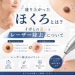 盛り上がったほくろとレーザー除去について